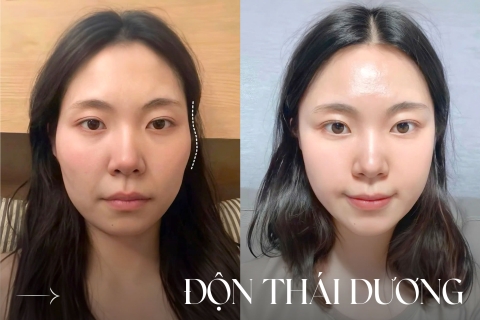 Độn thái dương